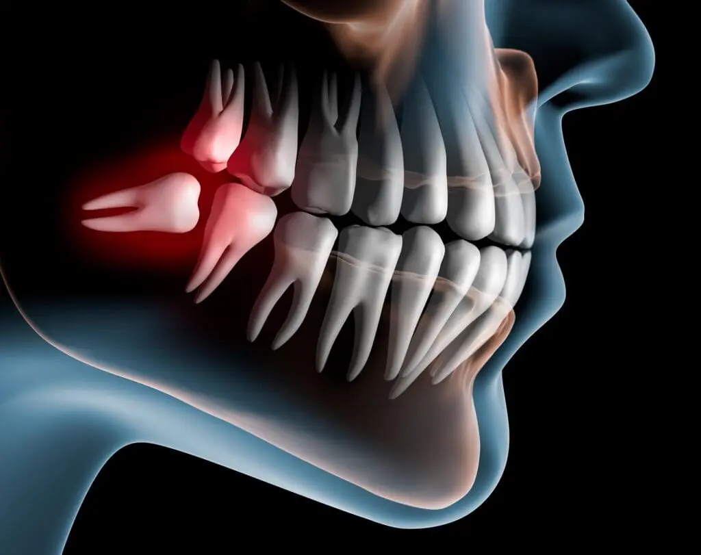 impacted wisdom tooth image