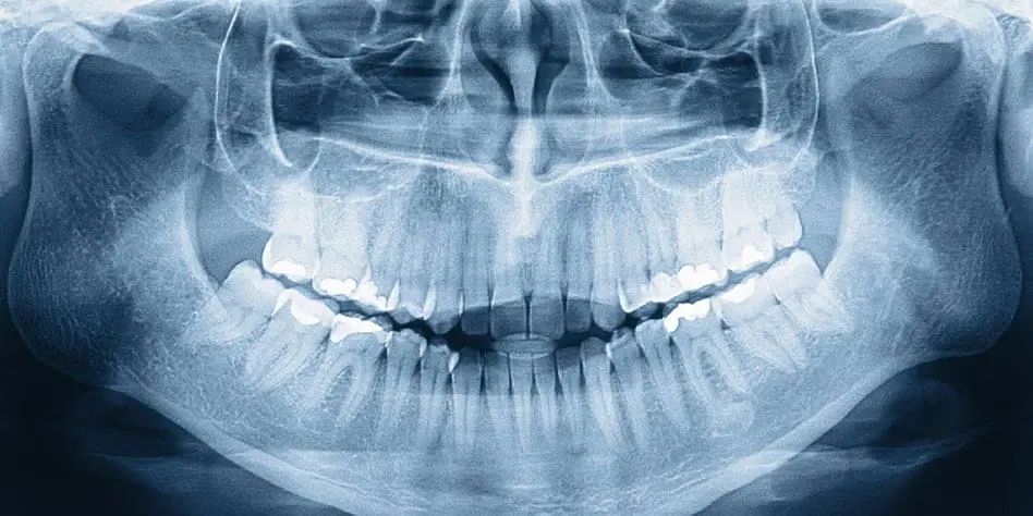 xray of teeth from legacy surgery in virginia