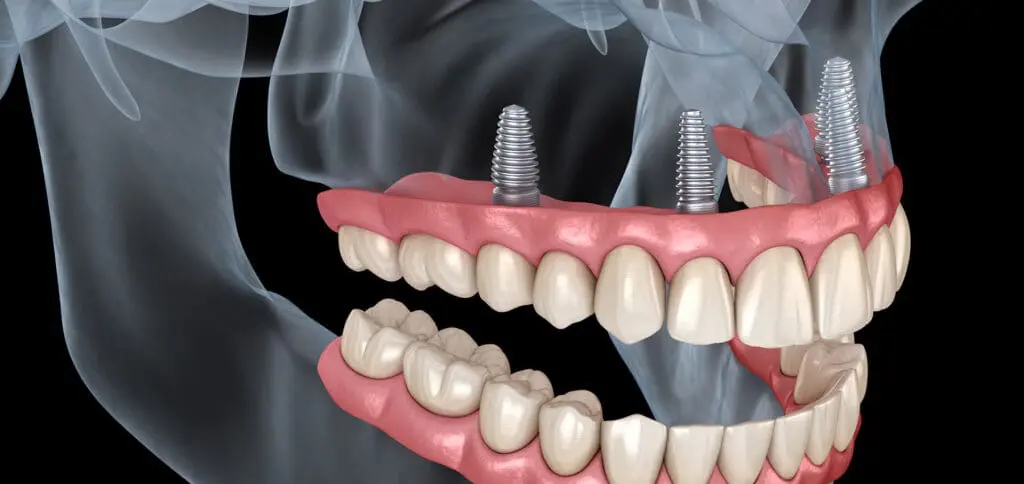 All-on-4® Dental Implants