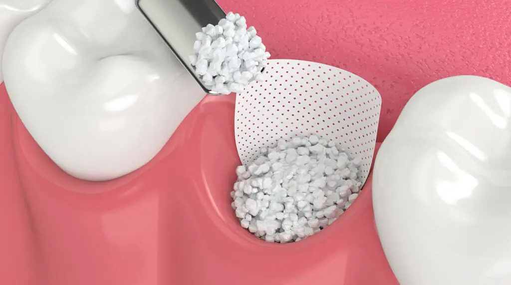 Bone Grafting at Legacy Surgery