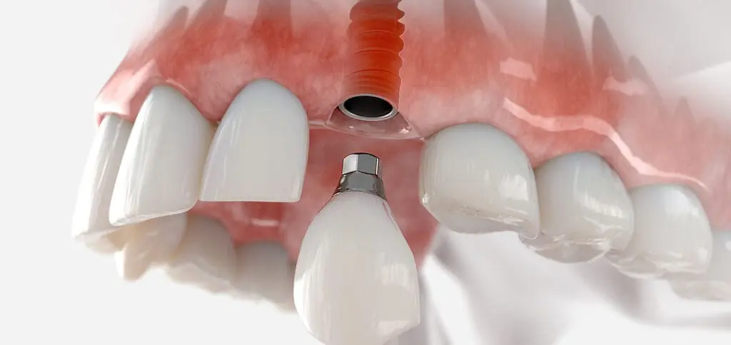 About Dental Implants