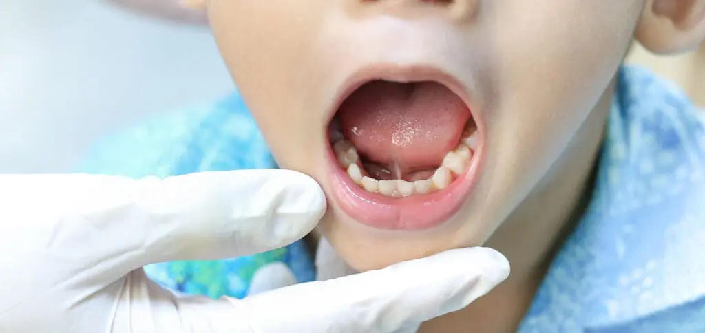 Frenectomy Procedure at Legacy Surgery