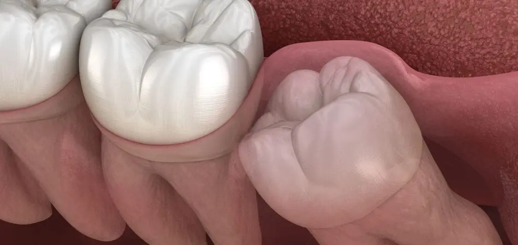 Treatment for Impacted Teeth at Legacy Surgery
