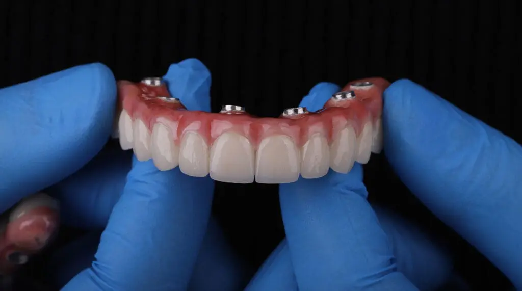 Implant-Supported Dentures at Legacy Surgery
