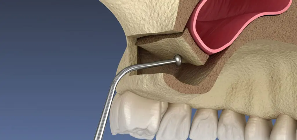 Sinus Lift at Legacy Surgery