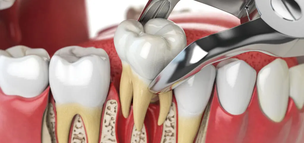 Tooth Extraction at Legacy Surgery