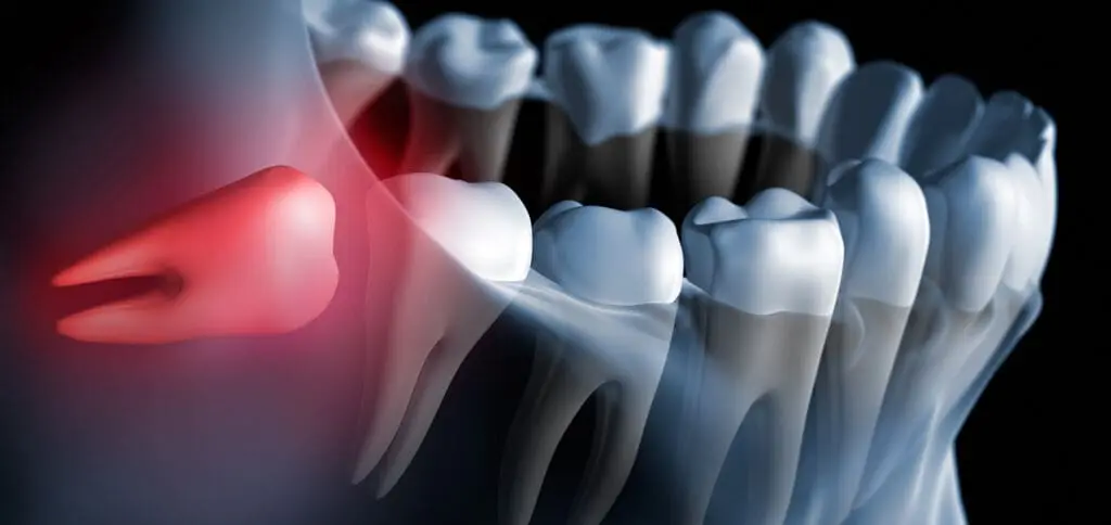Gentle Wisdom Tooth Removal at Legacy Surgery