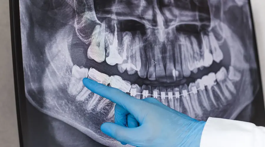 X-Ray of Wisdom Teeth X-Ray of Wisdom Teeth