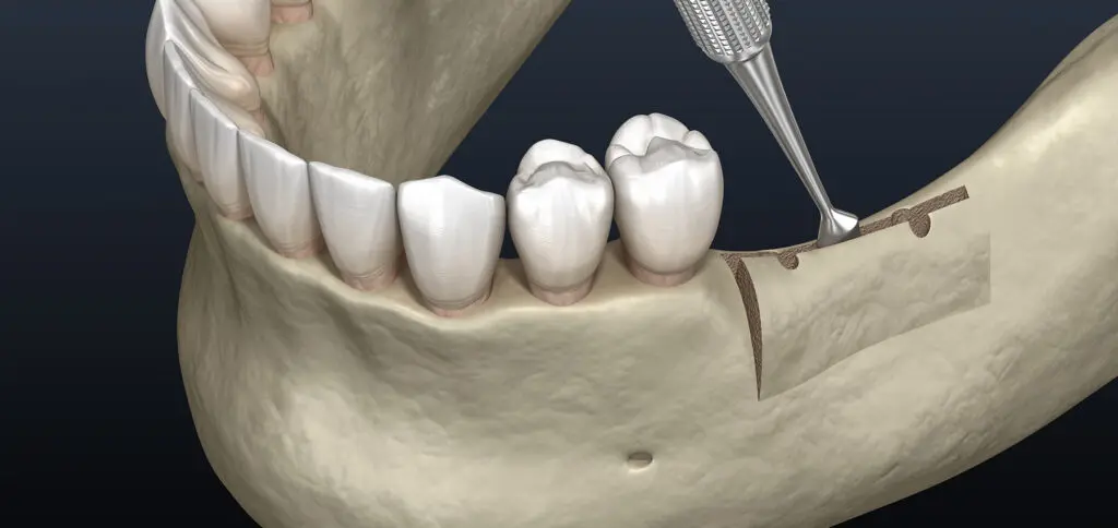 Ridge Augmentation Ridge Augmentation