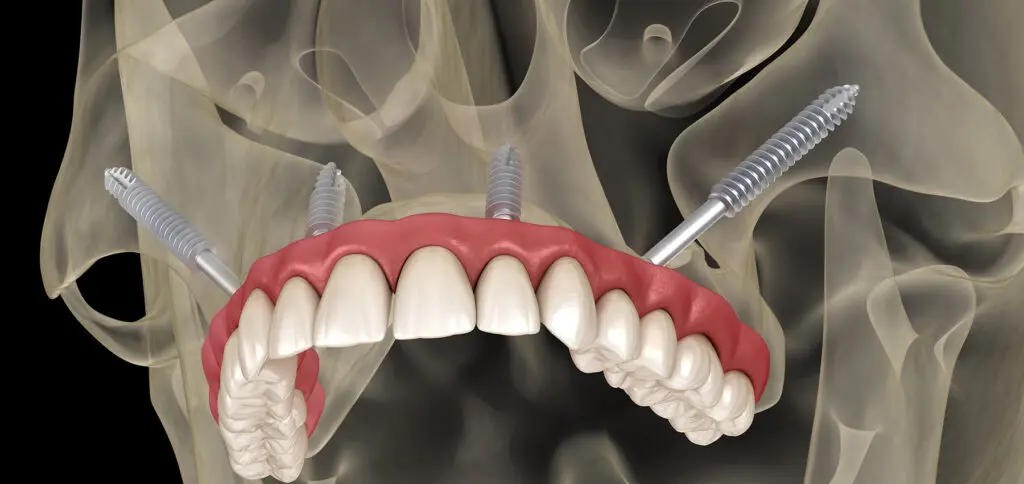 Zygomatic Implants Zygomatic Implants