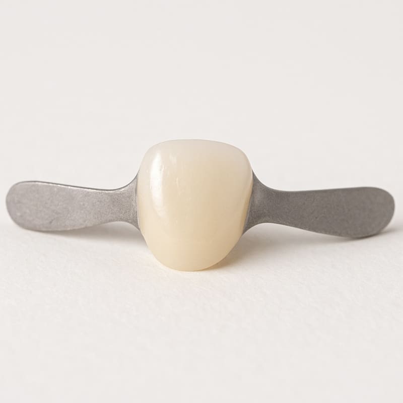 Maryland Bridge dental prosthesis with a ceramic tooth and two metal wings on a light background