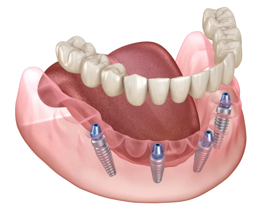 All on 4 Legacy Dental Implants